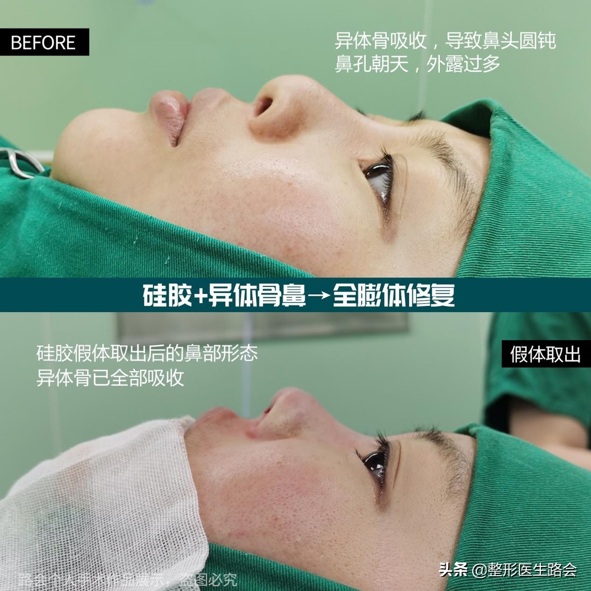 鼻子硅胶假体取出来真实感受,取出硅胶假体鼻子1-7天恢复过程图