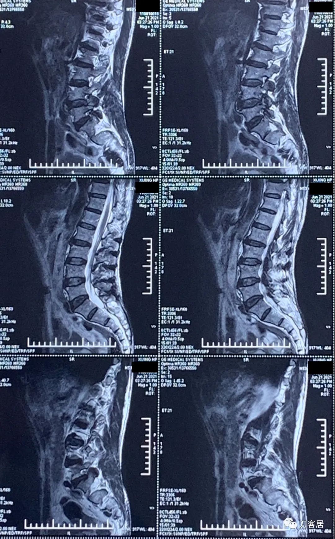髋部疼，小腿肚胀、抽筋，折腾了5年没效果，能用阿仑膦酸钠吗？