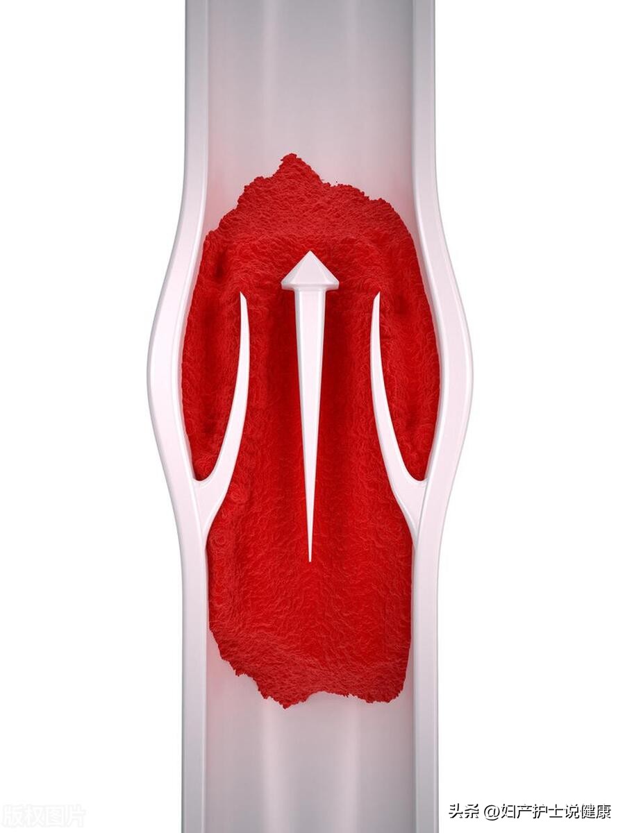 男人到底该不该穿长筒袜,做什么手术要穿弹力袜