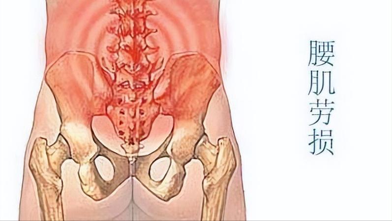 腰肌劳损导致腰疼最快缓解方法,腰肌劳损缓解腰痛的最佳动作