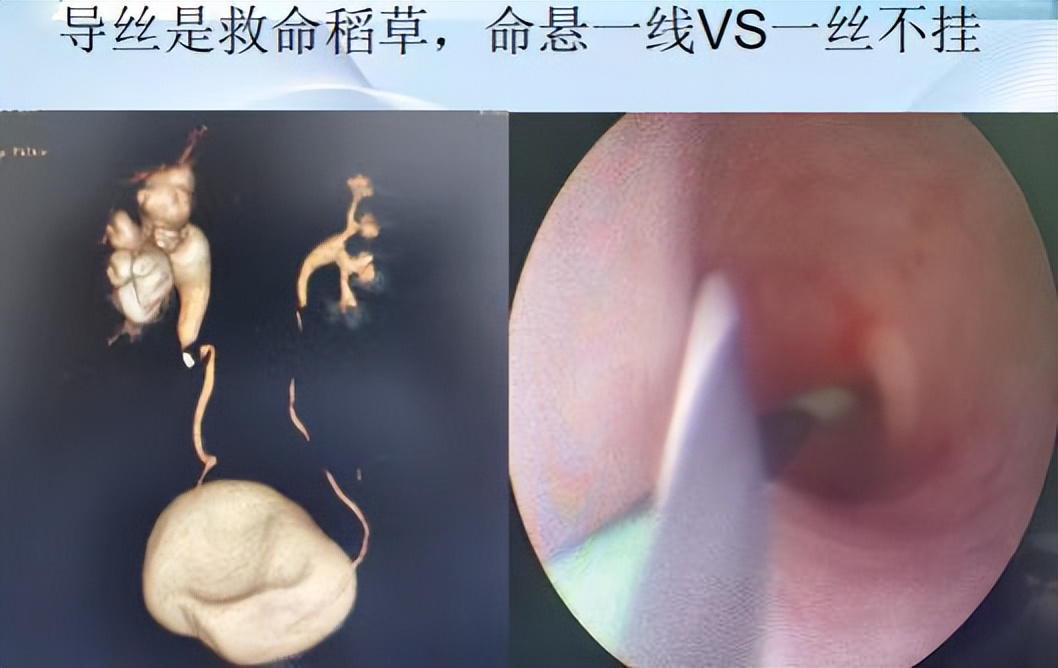 明知山有虎,偏向虎山行——肾斗士VS肾结石