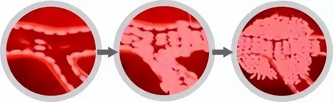 孩子颈部鼓起一个硬包图片,小孩颈部有鼓包颜色变重