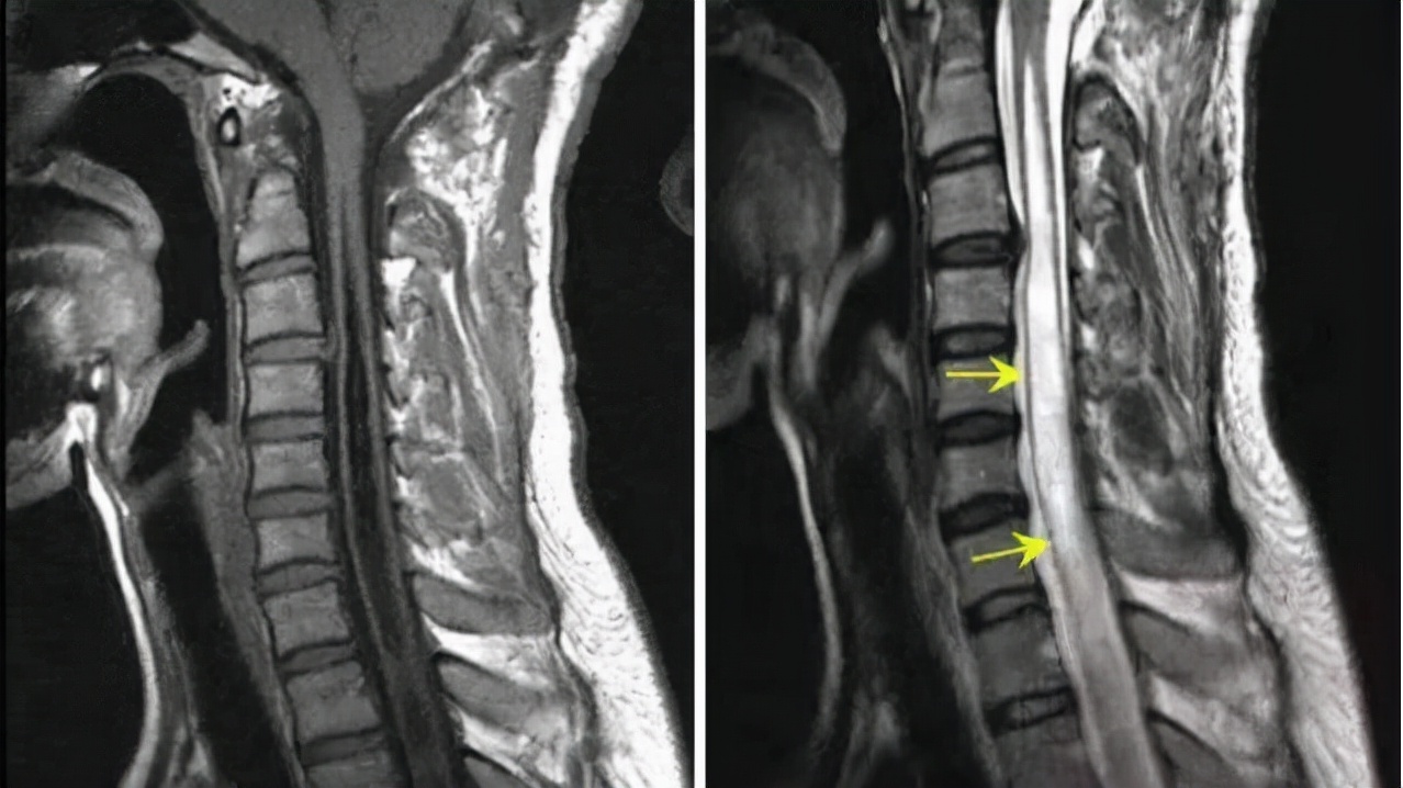 脊髓空洞症核磁会误诊吗,核磁显示脊髓空洞是什么意思