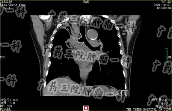 肺癌iva期怎么治疗,肺癌iva期值得治吗