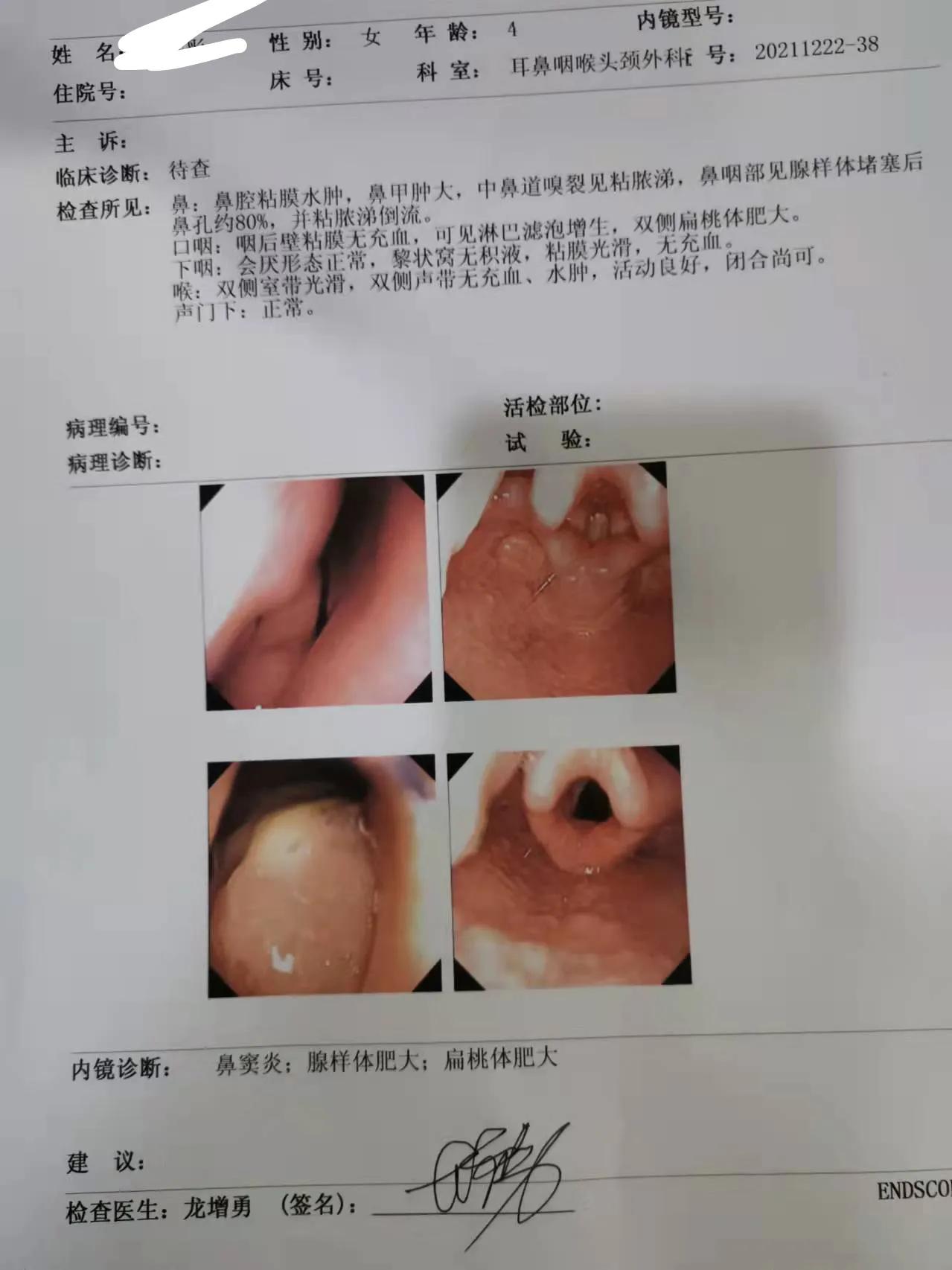 宝宝腺样体扁桃体手术,腺样体肥大扁桃体手术