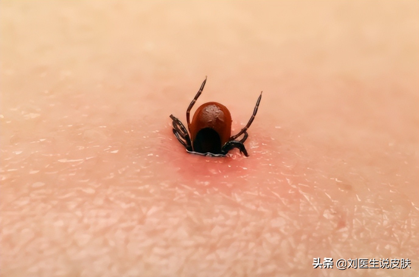 蜱虫可传播多种致命疾病,蜱虫叮咬可引起哪些疾病