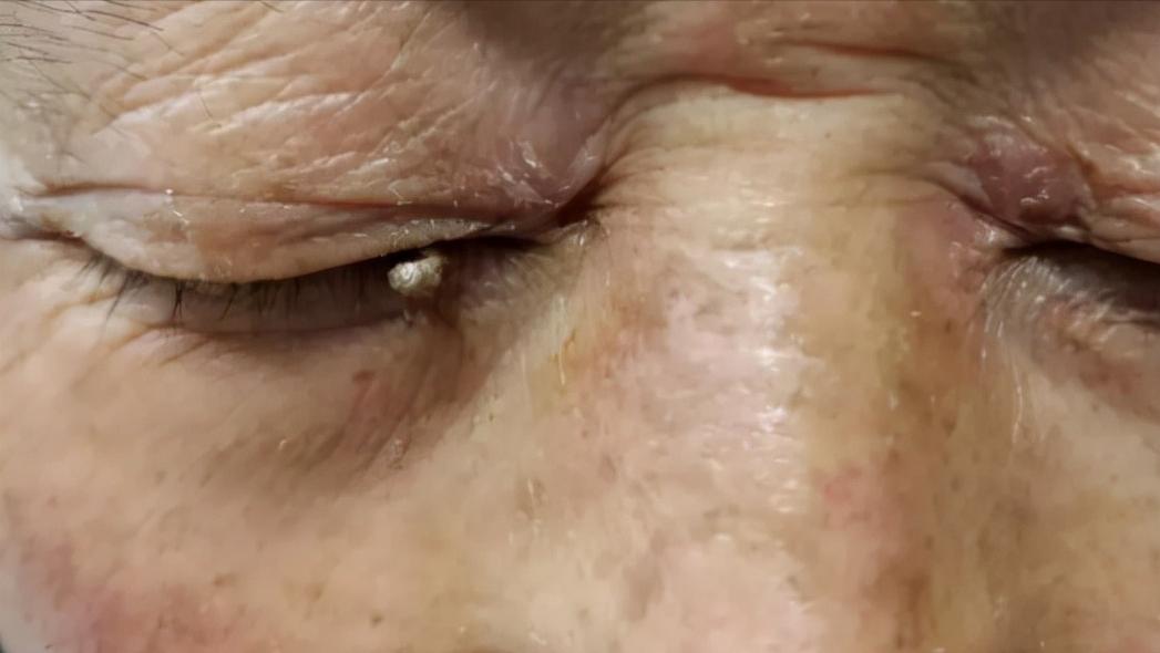 hpv和疣是一种病吗,hpv病毒疣是什么样的