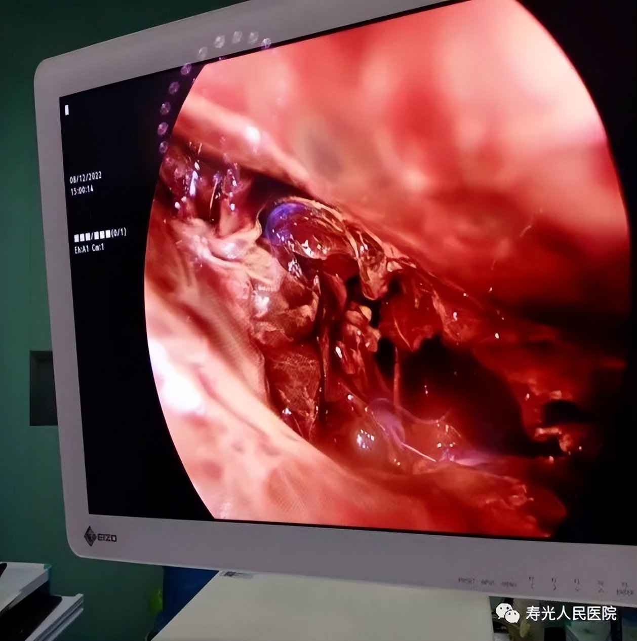 寿光人民医院呼吸与危重症一科,寿光人民医院住院的视频