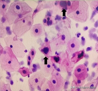 宫颈癌筛查TCT、HPV傻傻分不清，病理科为您来揭秘