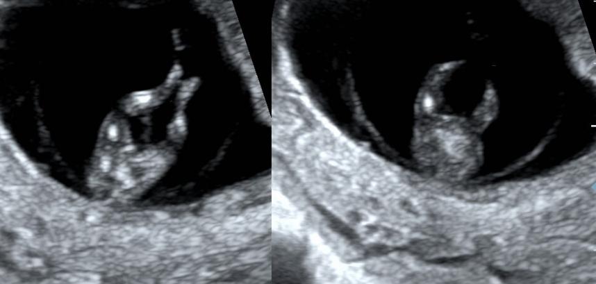 怀孕三个月胎儿是什么样的,怀孕三个月平躺可以摸到胎儿吗