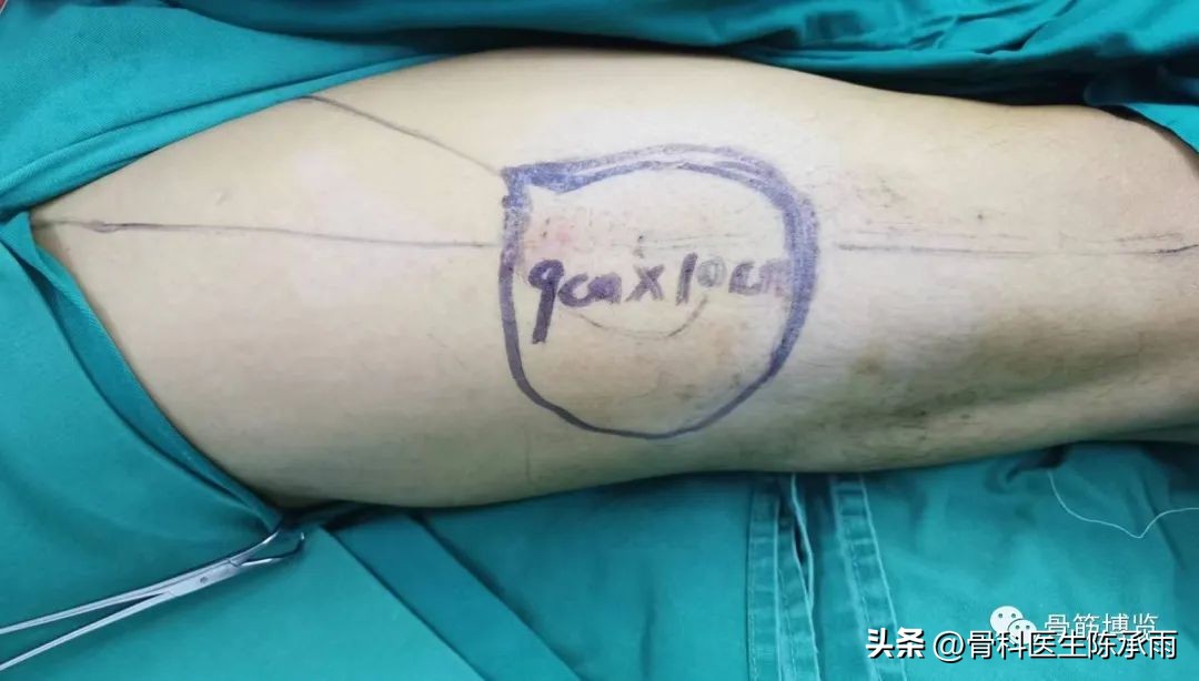 娓哥鐨摚淇,涔旀皬鐨摚淇瓒宠儗澶栦晶鐨偆缂烘崯