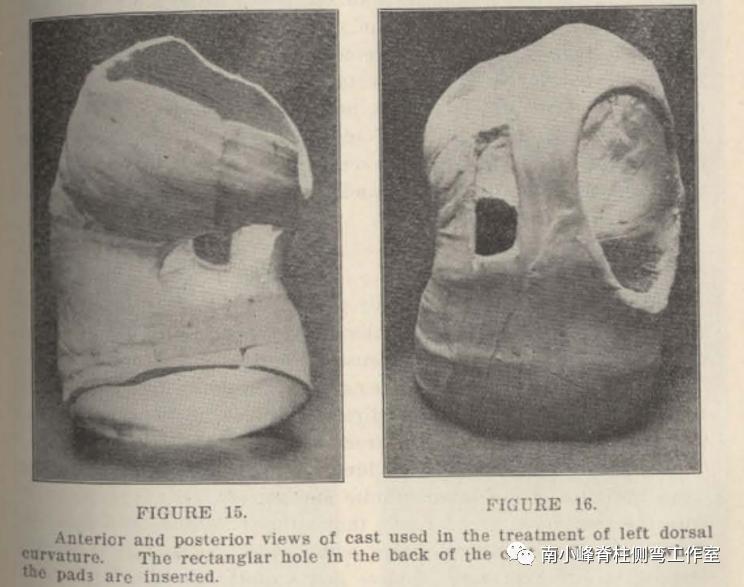 gbw硬质支具矫正脊柱侧弯,gbw支具案例