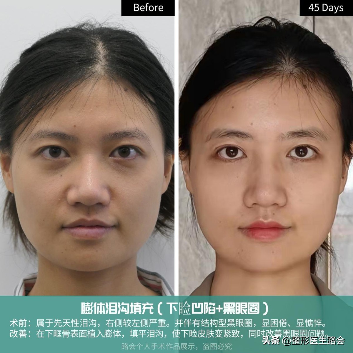 29岁眼袋黑眼圈泪沟严重怎么处理,35岁做泪沟眼袋最好的方法