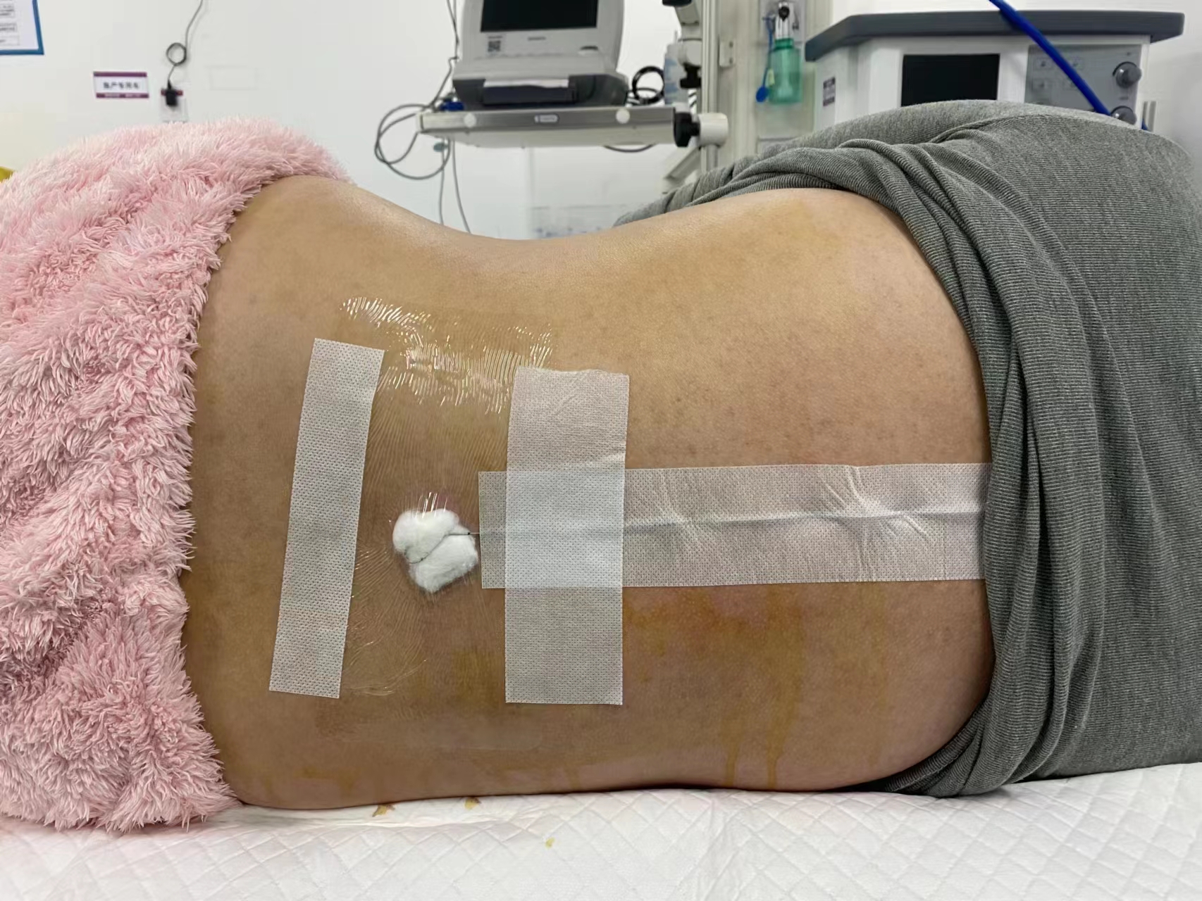 剖宫产需要分娩镇痛嘛,分娩阵痛产妇的观察及注意事项