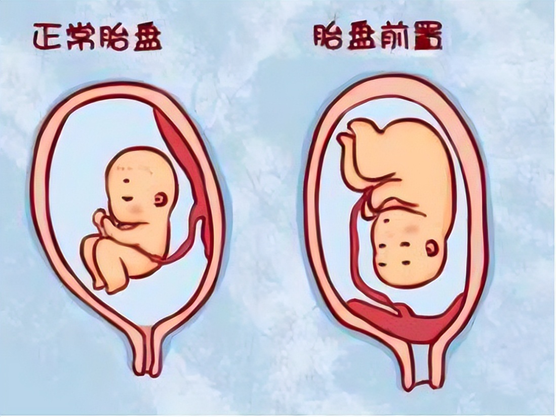 凶险性前置胎盘和完全性前置胎盘,凶险性前置胎盘成功率高吗