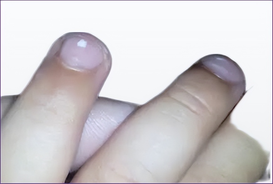 宝宝指甲有白斑是肚子有虫吗,一周半宝宝指甲上有白点怎么回事