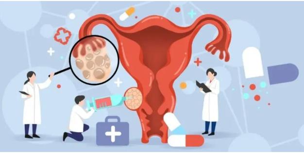 不只是避孕!这种短效避孕药可减少子宫内膜息肉复发