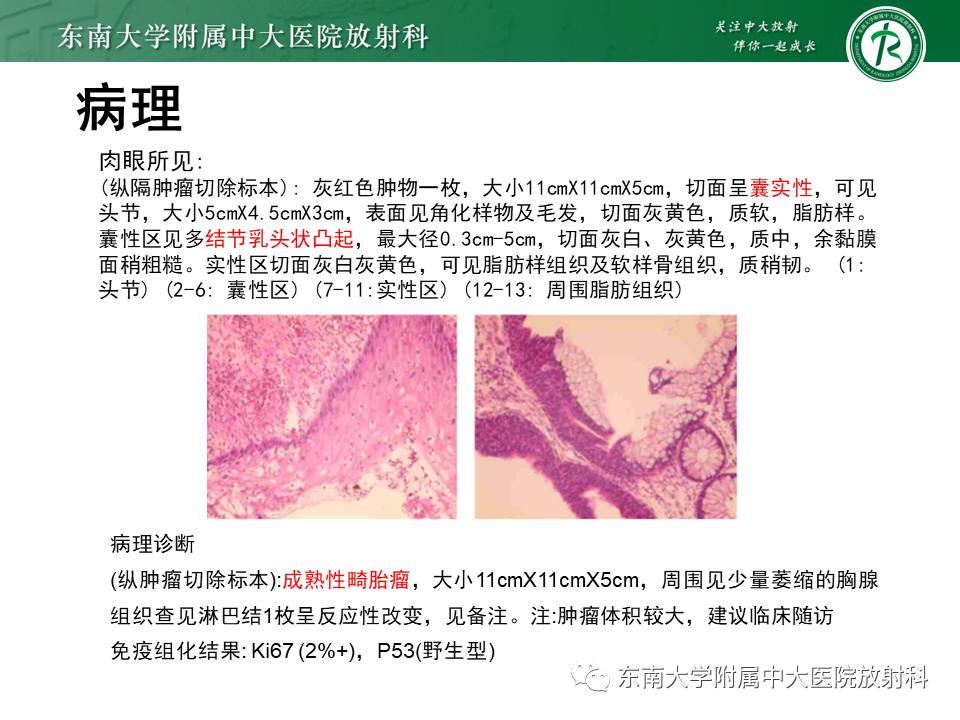 好文分享值得深思,纵隔精原细胞瘤