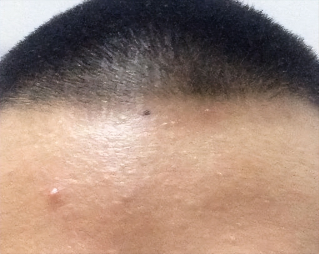 孩子背后长痣代表什么,孩子背后有痣代表什么