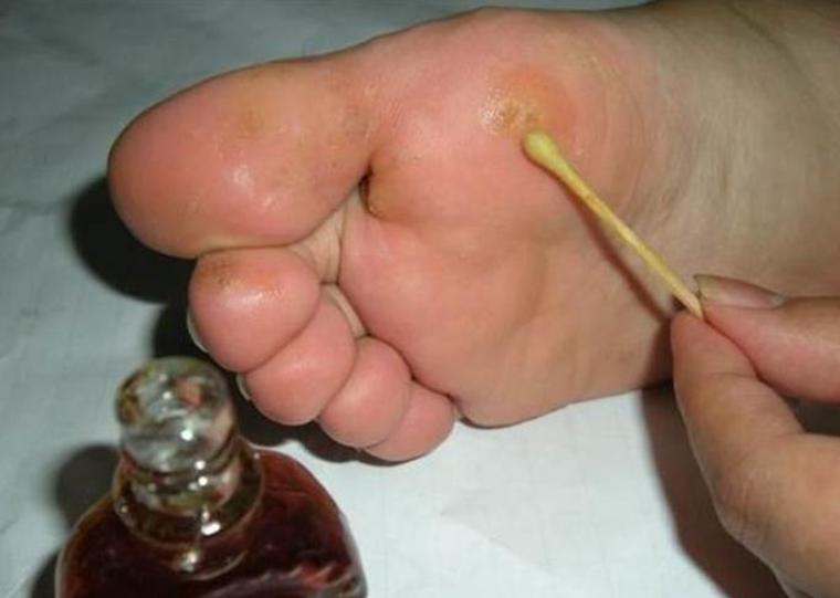 脚气真菌怎么治才能除根,脚气真菌怎么彻底消灭