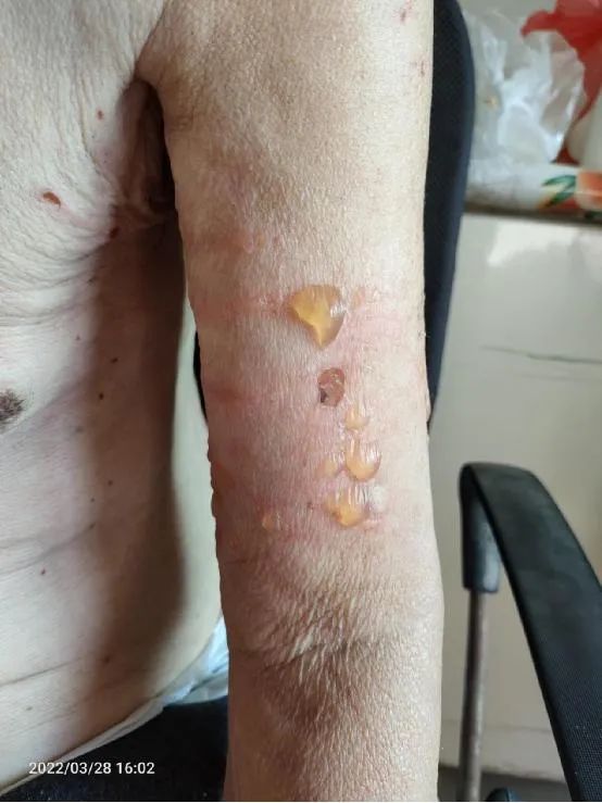 惊！一夜醒来胳膊上全是泡！二期皮肤压力性损伤该如何护理？