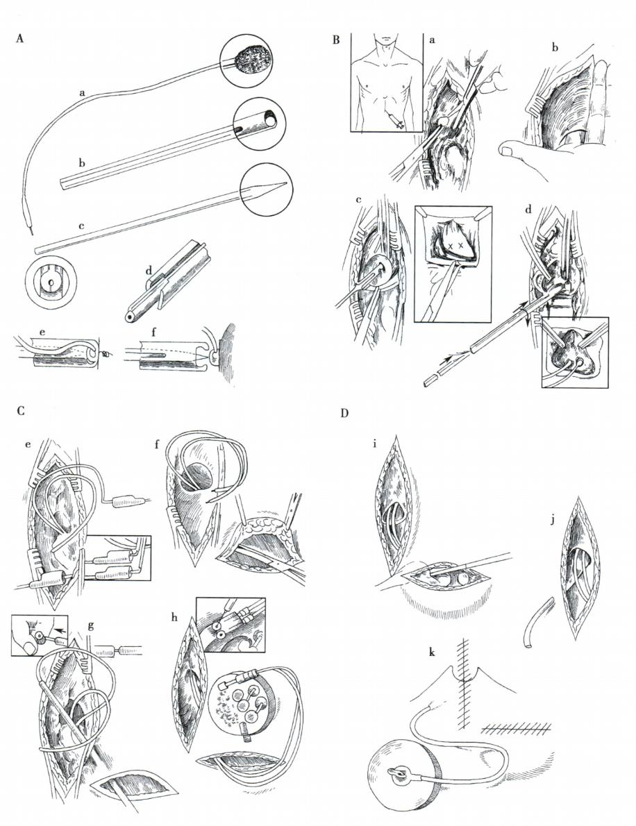 安置心脏起搏器,心脏装起搏器后需要注意些什么