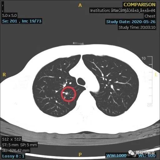 炎症引起的肺实性结节生长速度,肺部结节影像学读片讲解视频