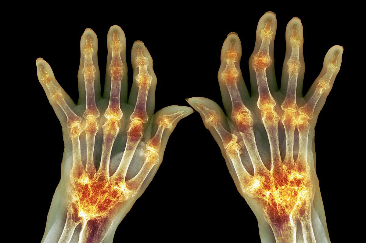 类风湿选用甲氨蝶呤来氟米特,甲氨蝶呤与来氟米特治疗类风湿