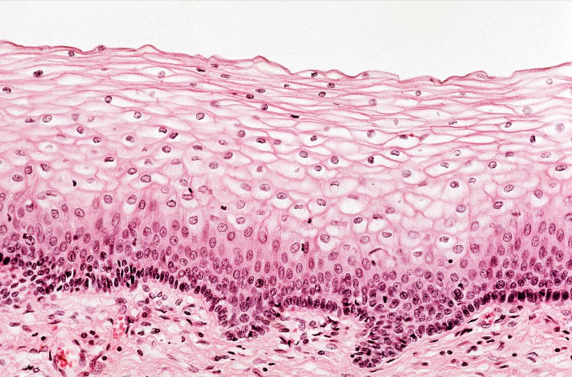 派特灵生物科普｜子宫颈低级别鳞状上皮内病变管理的中国专家共识