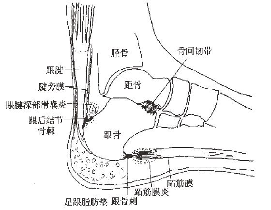 知足常乐足部护理,足跟痛的克星一览表