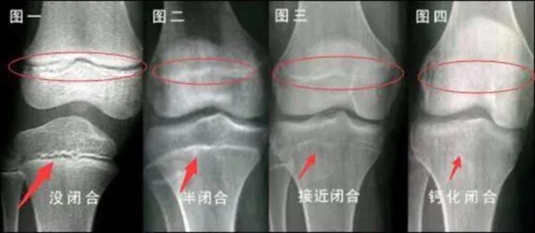 影响孩子长高的六个关键因素,影响孩子长高的几大因素