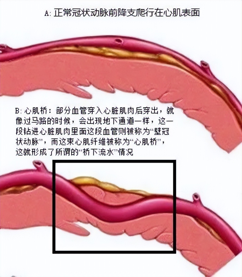 发现浅表性心肌桥多久复查,心肌桥最新发现