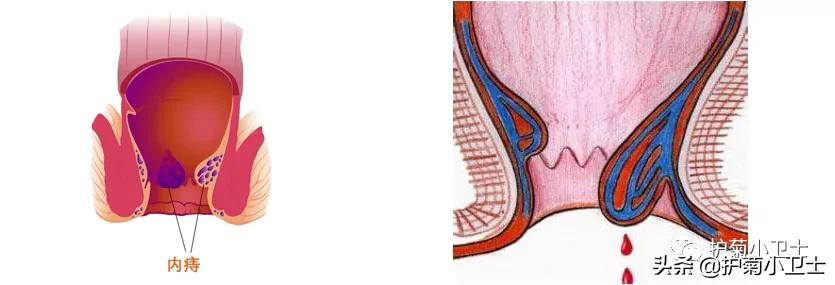 便血别担心不一定是直肠癌,便血不一定是肠癌吗
