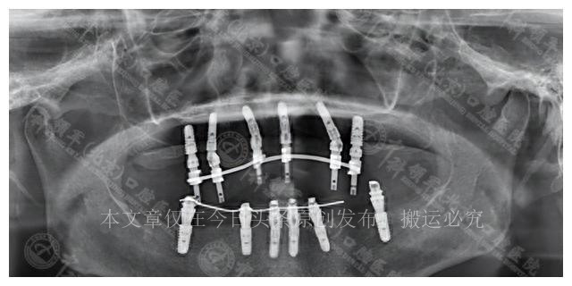 女儿做种植牙手术,老年人做全口种植牙