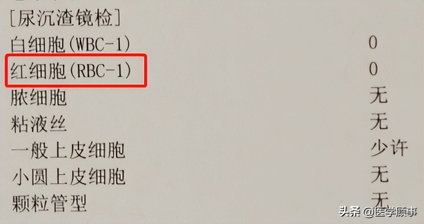 尿分叉尿流变细是怎么回事,尿分叉和尿次数多是什么原因