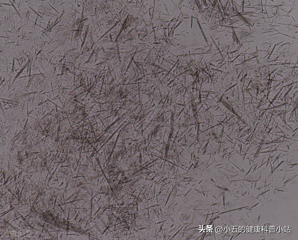 吃苯溴马隆降尿酸痛风发作怎么办,苯溴马隆治疗尿酸高效果怎么样