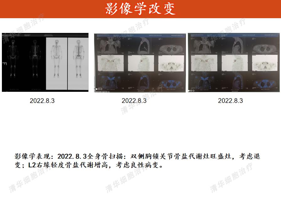 乳腺癌靶向药用后腰疼是什么情况,乳腺癌靶向治疗期间可以吃中药吗