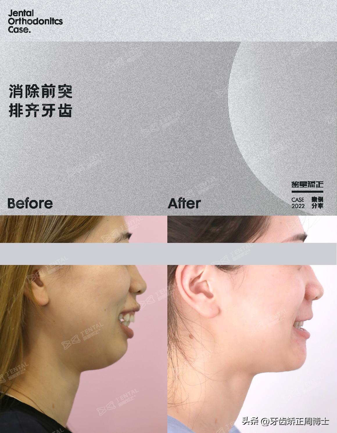 骨性前突正畸后多长时间有效果,牙性下巴后缩可以戴牙套改善吗