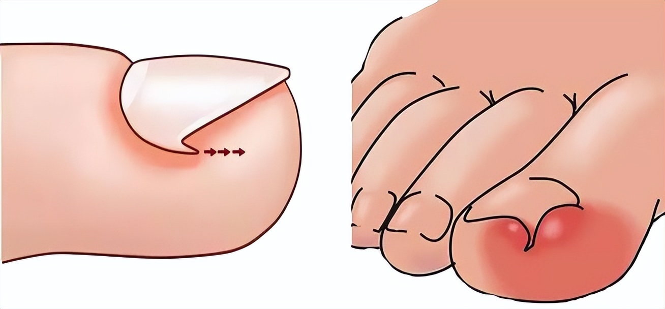 一走路脚指甲里疼怎么回事,一走路脚趾骨疼痛是什么原因呢