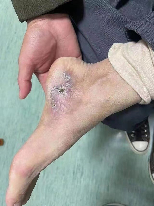 38岁脚底长瘤,脚脖子长疙瘩会有哪些恶性肿瘤