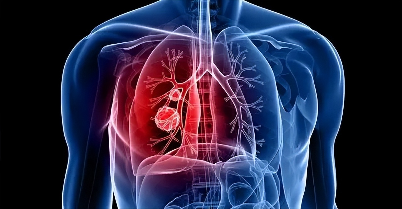 扁桃体息肉囊肿增生怎么区分,结节息肉囊肿增生的区别