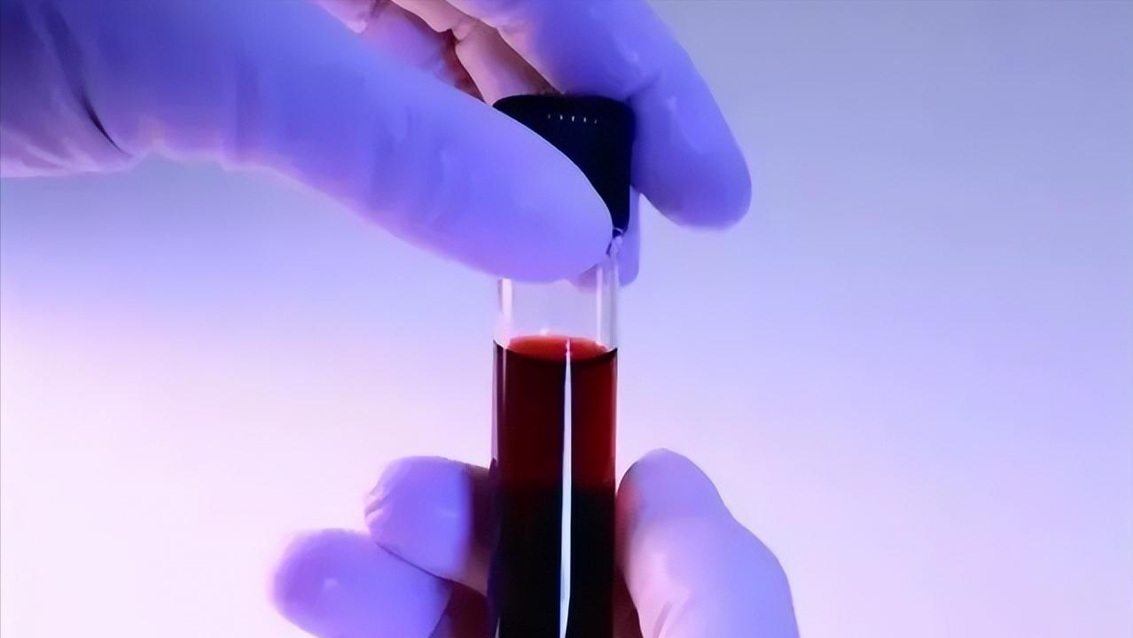 幽门螺旋杆菌阳性dpm值1145严重吗,幽门螺旋杆菌阳性值为00340严重吗