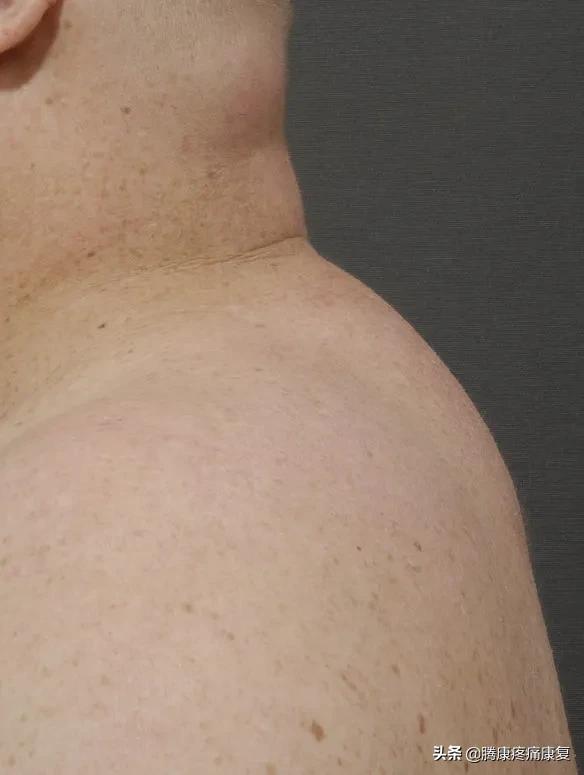 颈后有大包最快速的恢复方法,一招解决颈后大包