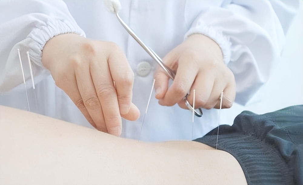 刺络拔罐联合常规针刺治疗神经根型颈椎病如何治疗?疗效如何?