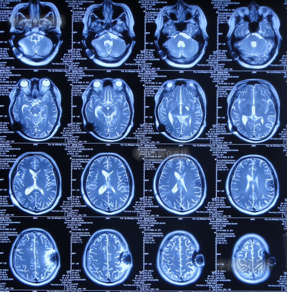 脑积水三脑室造瘘多久能恢复,脑囊虫手术后脑积水