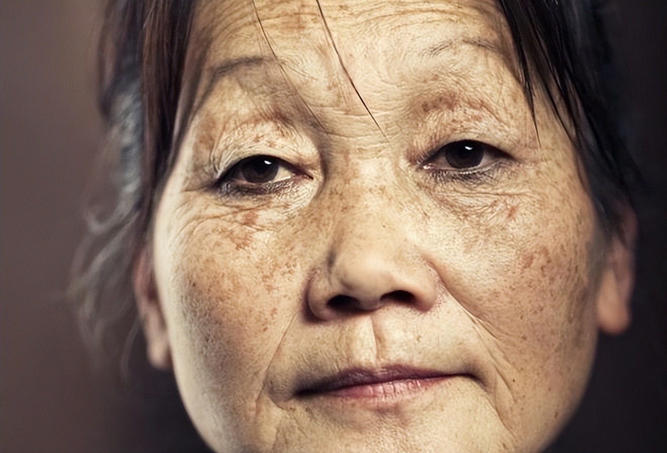 红霉素软膏可以去除老年斑吗,治疗脸上老年斑涂抹什么药膏