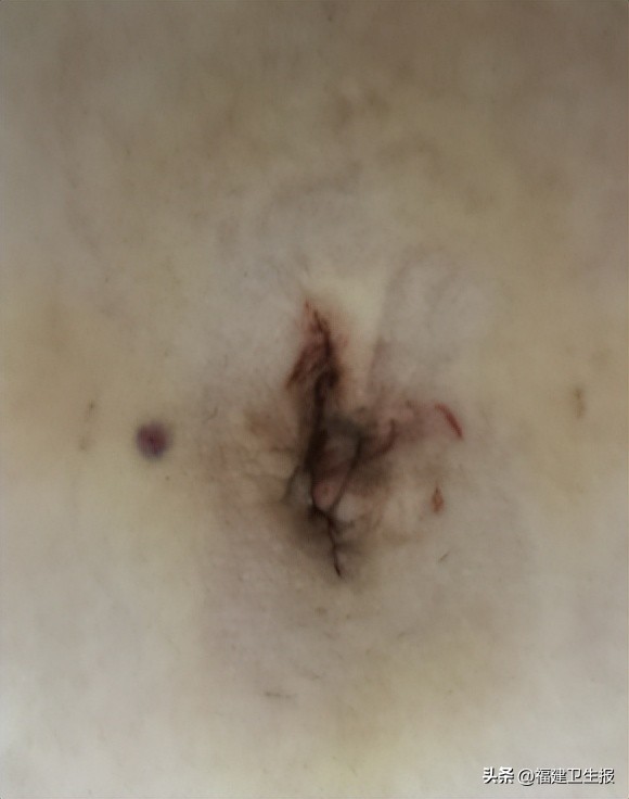 少女卵巢里长满毛发、牙槽骨!省妇幼保健院孙蓬明教授团队仅用2厘米切口巧取足球大小“怪胎”