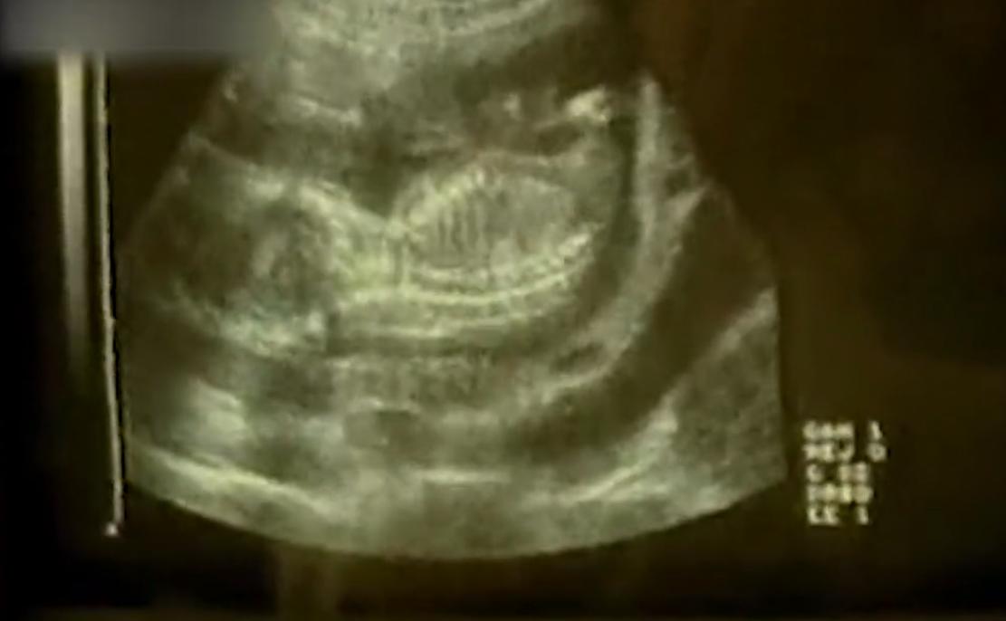 真实故事女子意外怀孕,女子突然肚子痛怀孕小产