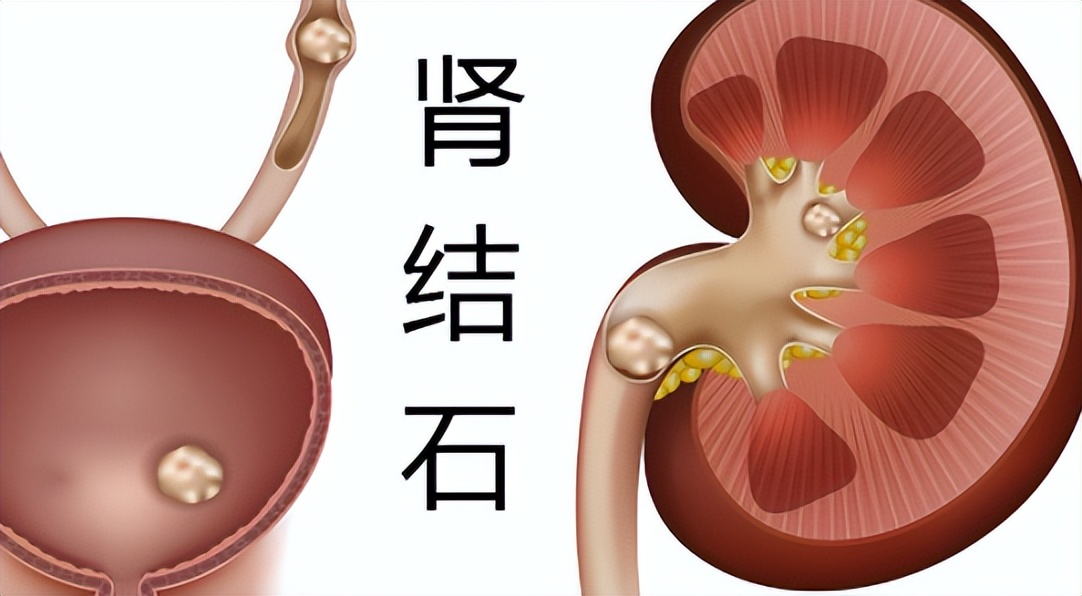 肾结石能吃蛋一类的食物吗,肾结石治疗期间可以吃鸡蛋吗