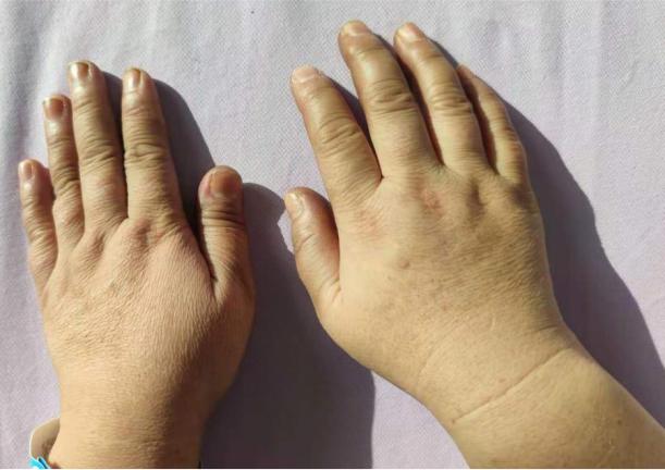 脑梗偏瘫后注意事项,脑梗偏瘫肢体恢复期最初锻炼方法